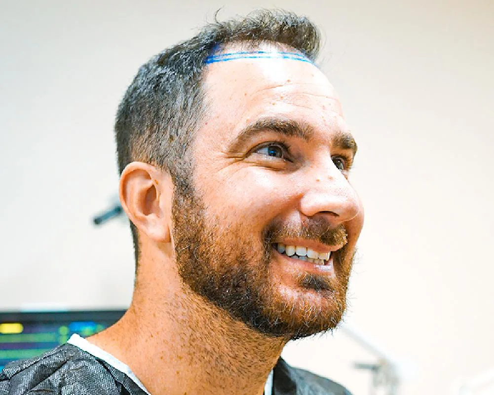 Uomo sorridente con la nuova attaccatura tracciata in blu prima di un trapianto DHI