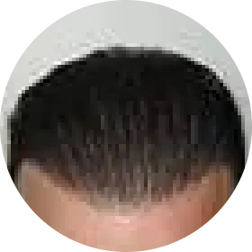 Attaccatura folta dopo la ricrescita dei capelli trapiantati
