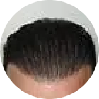 Gros plan d'une ligne frontale dense après la repousse des cheveux greffés