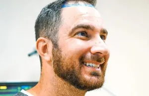 Uomo sorridente con l'attaccatura segnata prima di un trapianto DHI