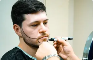 Uomo a cui viene tracciata con il pennarello la linea della barba prima di un trapianto di barba