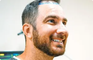Uomo sorridente con la nuova attaccatura tracciata in blu prima di un trapianto DHI
