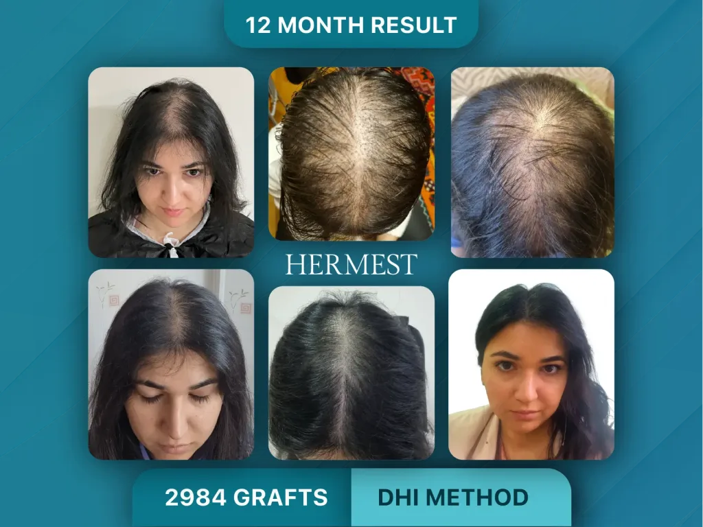 Trapianto di capelli prima e dopo, Metodo DHI – 2984 innesti