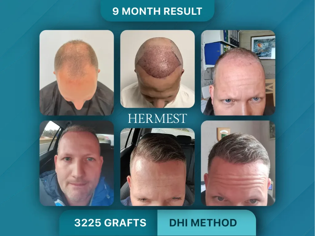 Trapianto di capelli prima e dopo, Metodo DHI – 3225 innesti