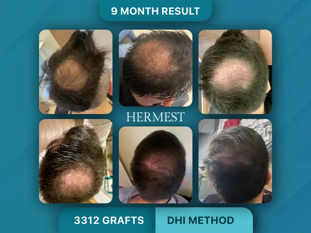 Trapianto di capelli prima e dopo, Metodo DHI – 3312 innesti