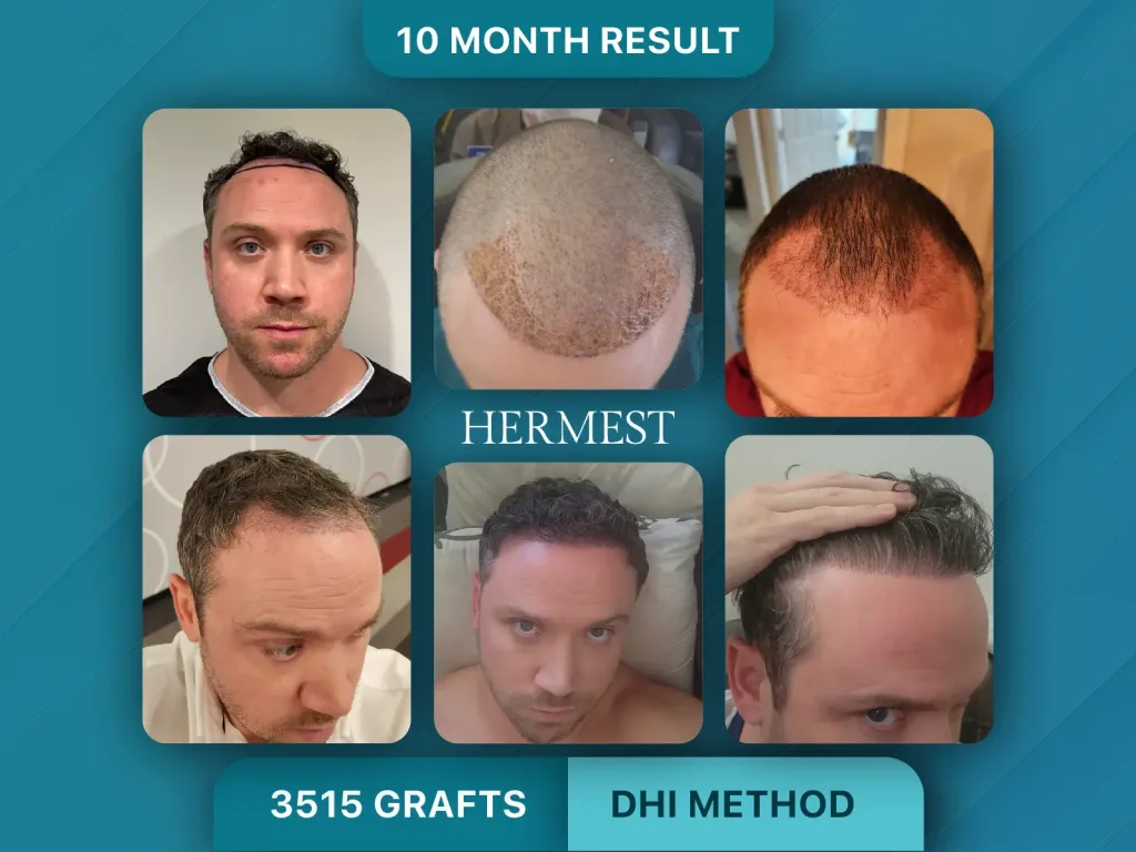 Trapianto di capelli prima e dopo, Metodo DHI – 3515 innesti
