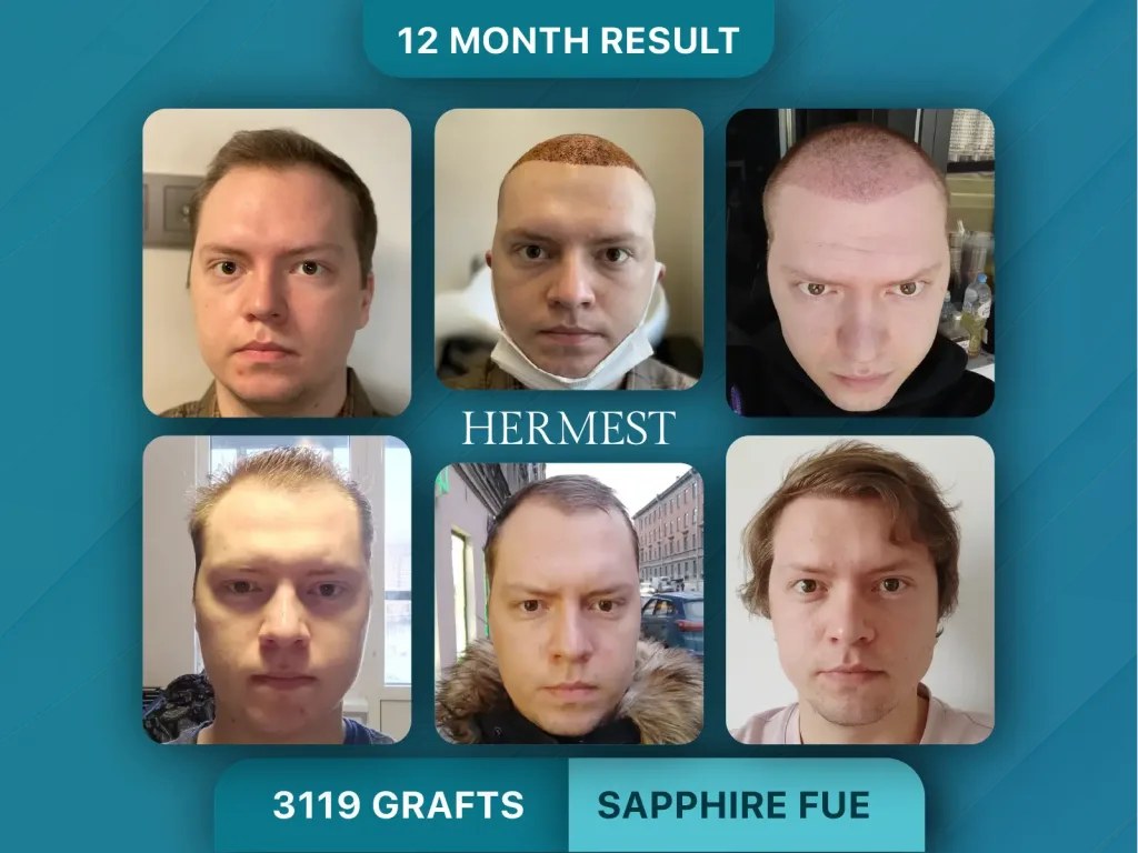 Trapianto di capelli prima e dopo, Sapphire FUE – 3119 innesti