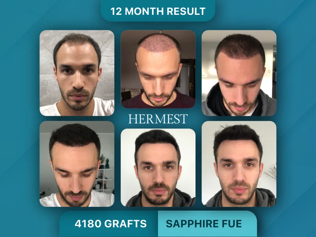 Trapianto di capelli prima e dopo, Sapphire FUE – 4180 innesti
