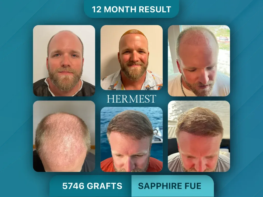 Trapianto di capelli prima e dopo, Sapphire FUE – 5746 innesti