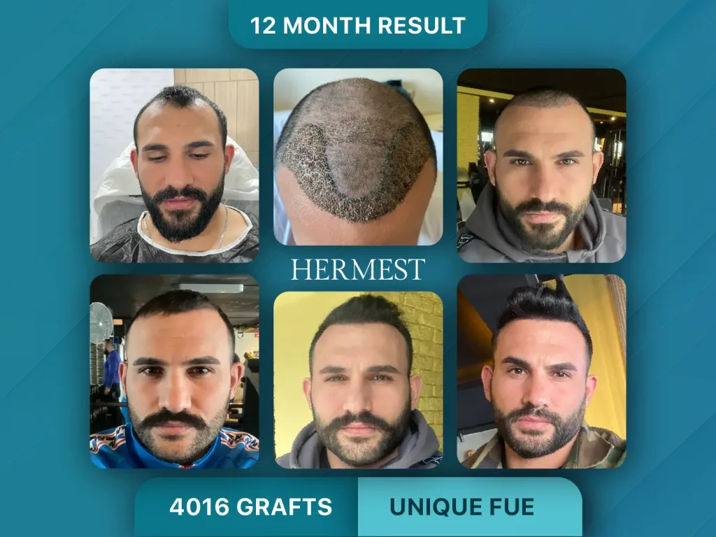 Trapianto di capelli prima e dopo, Unique FUE – 4016 innesti