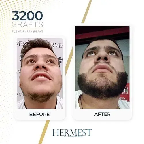 Trapianto di barba prima e dopo: giovane uomo con 3200 innesti
